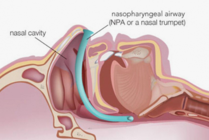 Nasopharyngeal Airway