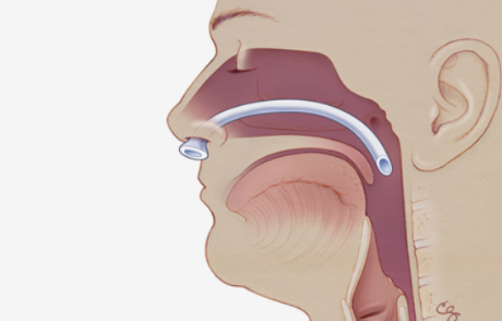 when to use a nasopharyngeal airway