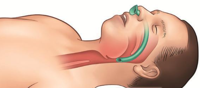 Nasopharyngeal Airway Advantages and Disadvantages