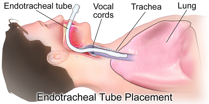 cuffed and uncuffed endotracheal tubes