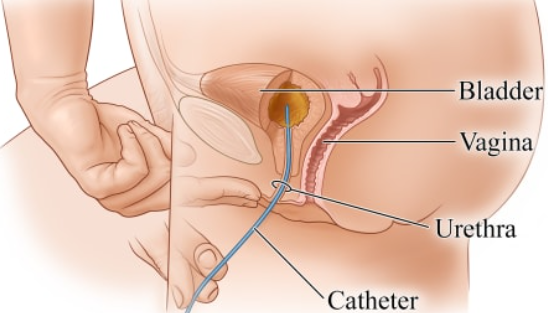 what size of catheter for female